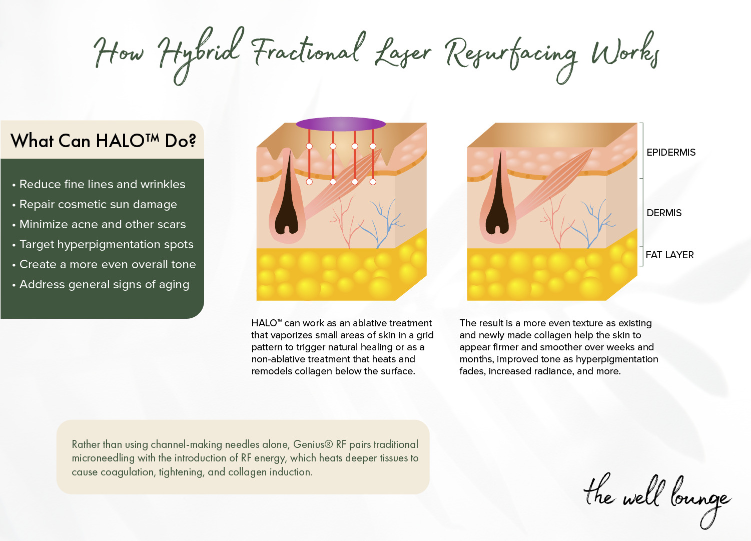See the benefits of HALO™ hybrid fractional laser resurfacing at Newtown, PA's The Well Lounge.